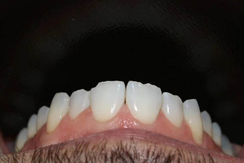 Bordos incisais desgastados