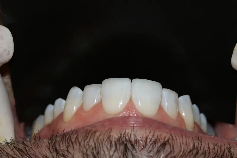 Restauração dos bordos incisais finalizada