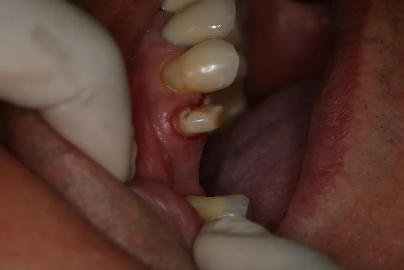 Dente comprometido antes do tratamento