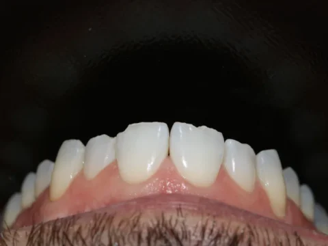 Restauração de bordo incisal — antes