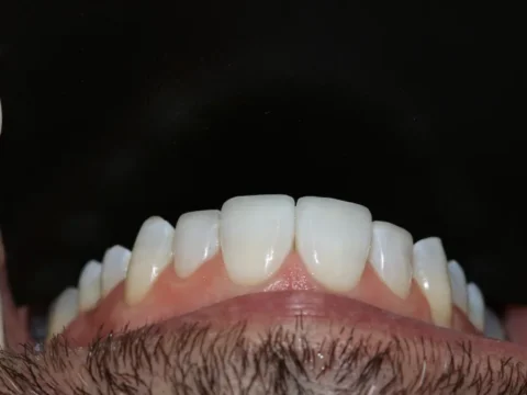 Restauração de bordo incisal — depois