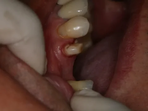 Coroa total em cerâmica — antes