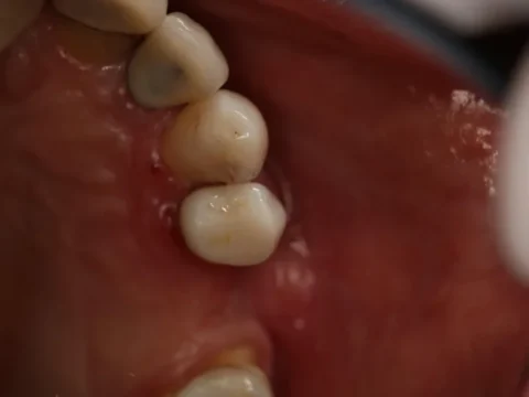 Coroa total em cerâmica — depois